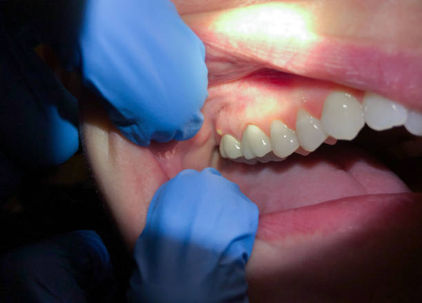 Best Emergency Dental Extractions in Sewalls Point, FL